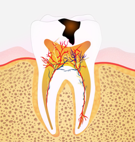 치수 우식(치수염